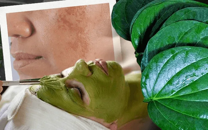 trị nám bằng lá trầu không