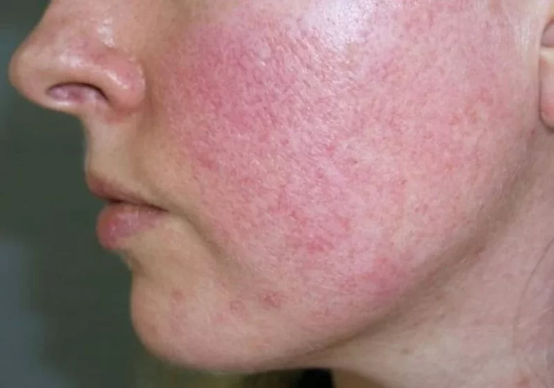 Tác hại của việc trị nám bằng laser
