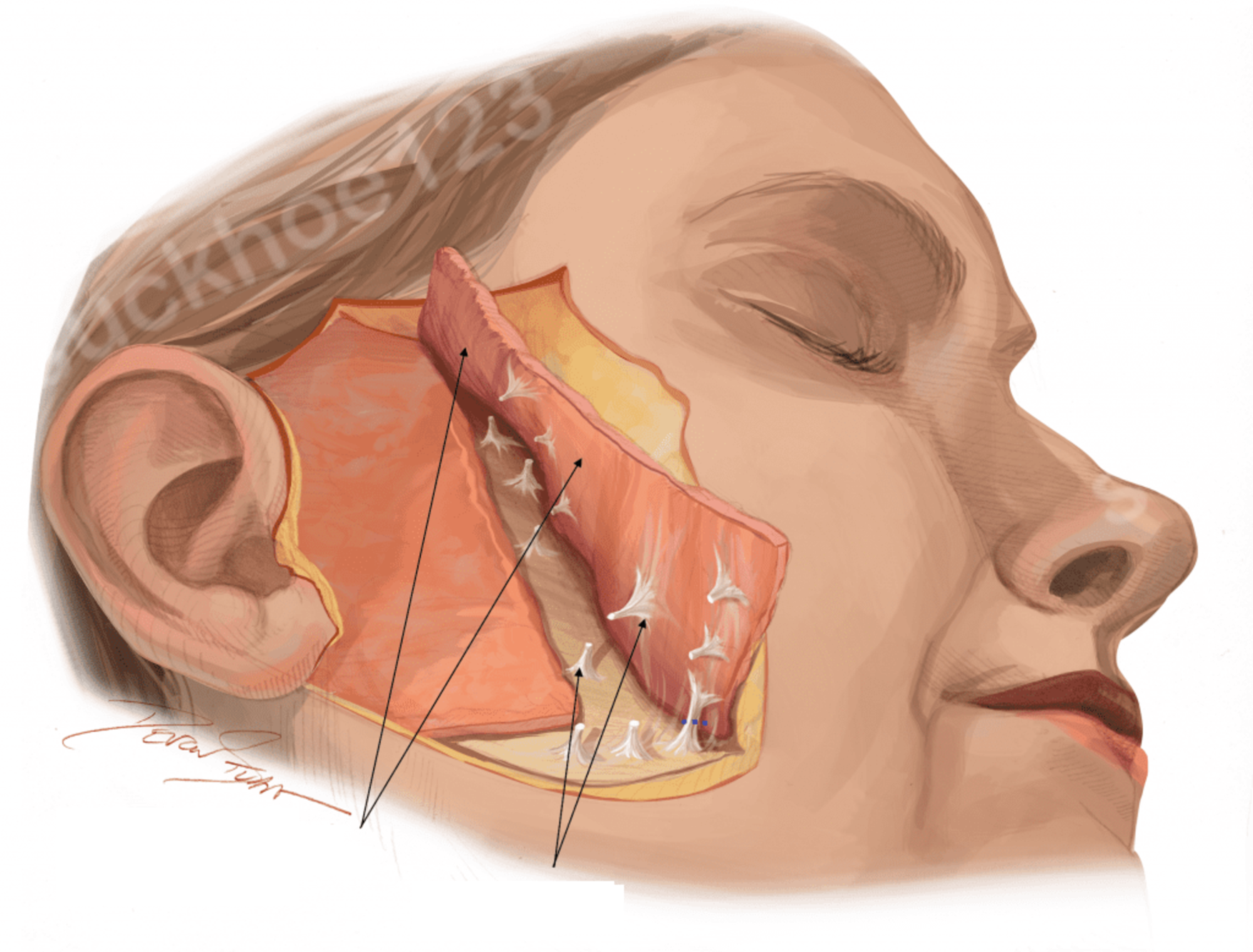 Tổng hợp 3 phương pháp căng da mặt hiệu quả nhanh chóng